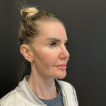 Instalift Before & After Patient #12234