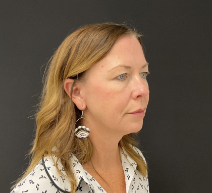 Blepharoplasty Before & After Patient #12228