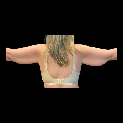 Brachioplasty Before & After Patient #12168