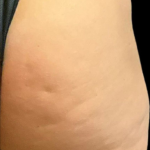 Alloclae Before & After Patient #12054