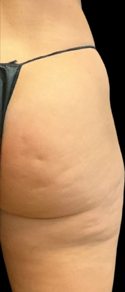 Alloclae Before & After Patient #12054