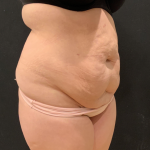Miami Makeover Before & After Patient #12241