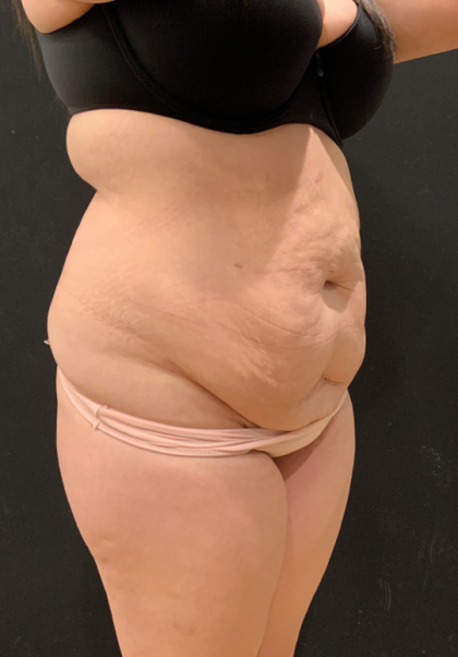 Miami Makeover Before & After Patient #12241