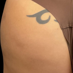 Alloclae Before & After Patient #12058