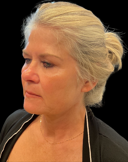 Brow Lift Before & After Patient #12050