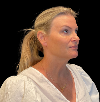 Blepharoplasty Before & After Patient #12229