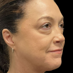 AVAVA Laser Before & After Patient #12237