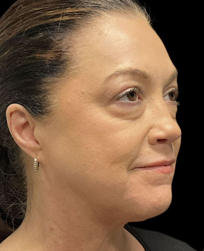 AVAVA Laser Before & After Patient #12237