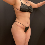 Miami Makeover Before & After Patient #12239
