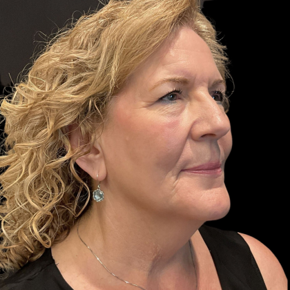 AVAVA Laser Before & After Patient #12238