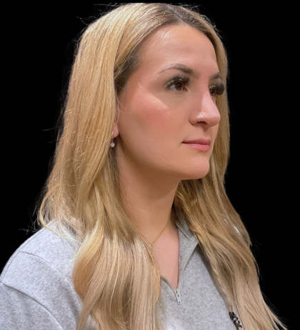 Chin Augmentation Before & After Patient #12231