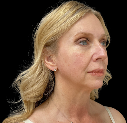 Brow Lift Before & After Patient #12048