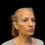 Blepharoplasty Before & After Patient #12227
