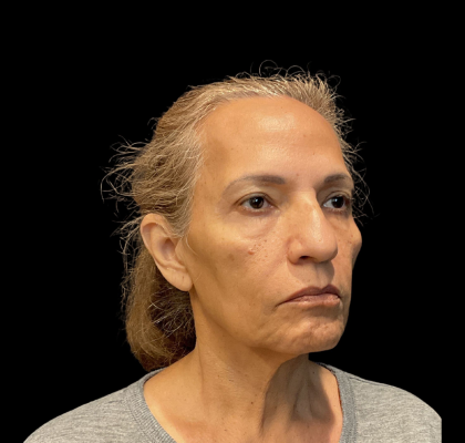 Blepharoplasty Before & After Patient #12227