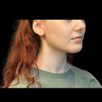 Chin Augmentation Before & After Patient #12230