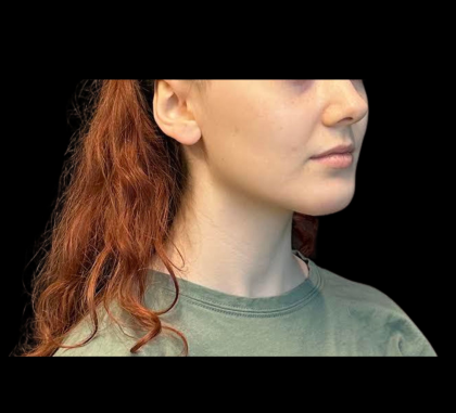 Chin Augmentation Before & After Patient #12230