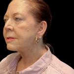 Facelift Before & After Patient #12052