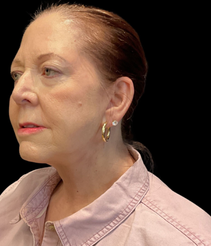 Facelift Before & After Patient #12052