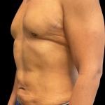 High Definition Liposuction Before & After Patient #12037