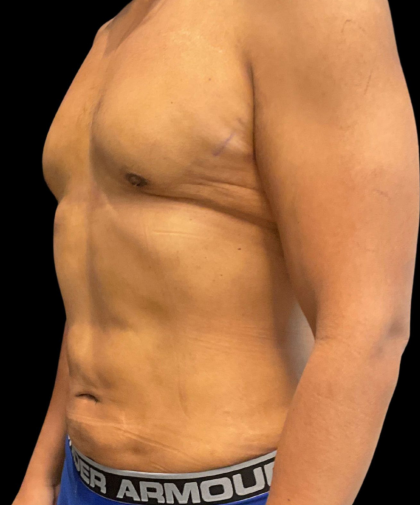 High Definition Liposuction Before & After Patient #12037