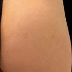 Alloclae Before & After Patient #12055