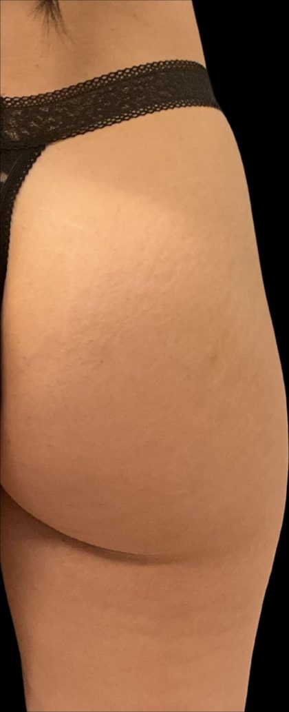 Alloclae Before & After Patient #12055