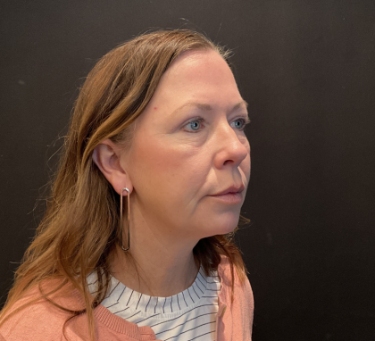 Blepharoplasty Before & After Patient #12228