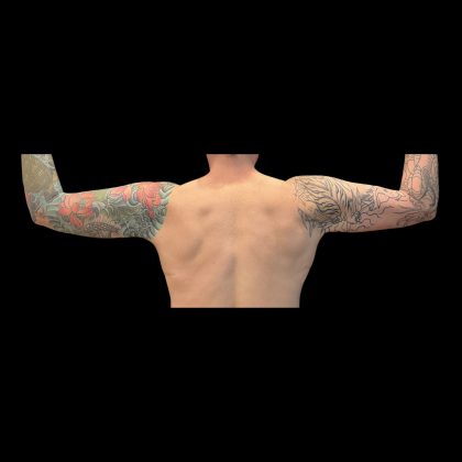 Brachioplasty Before & After Patient #12169