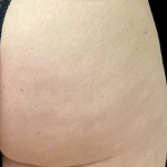 Alloclae Before & After Patient #12054