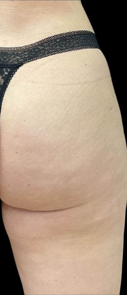 Alloclae Before & After Patient #12054