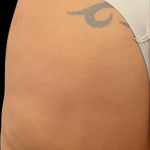 Alloclae Before & After Patient #12058