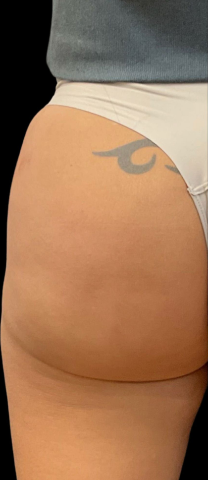 Alloclae Before & After Patient #12058