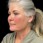 Brow Lift Before & After Patient #12050