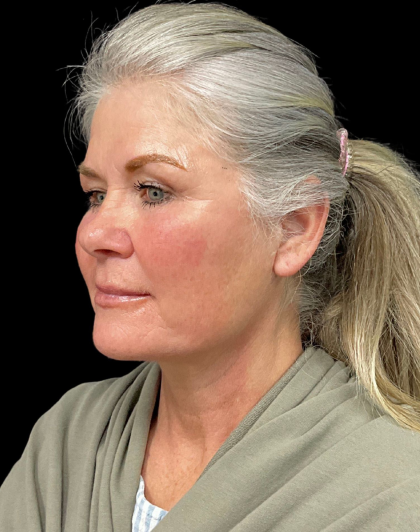 Brow Lift Before & After Patient #12050