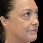 AVAVA Laser Before & After Patient #12237