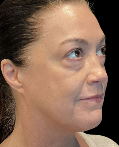 AVAVA Laser Before & After Patient #12237