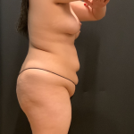 Miami Makeover Before & After Patient #12239