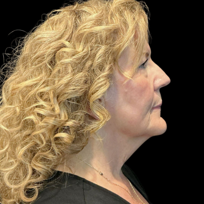 AVAVA Laser Before & After Patient #12238