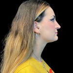 Chin Augmentation Before & After Patient #12231
