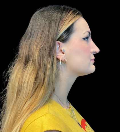 Chin Augmentation Before & After Patient #12231