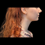 Chin Augmentation Before & After Patient #12230