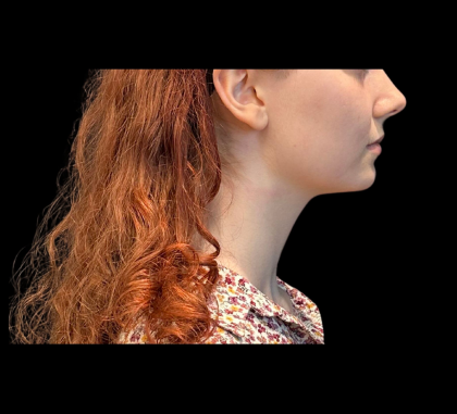 Chin Augmentation Before & After Patient #12230