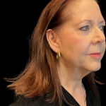Facelift Before & After Patient #12052