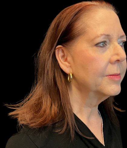 Facelift Before & After Patient #12052