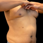 High Definition Liposuction Before & After Patient #12037