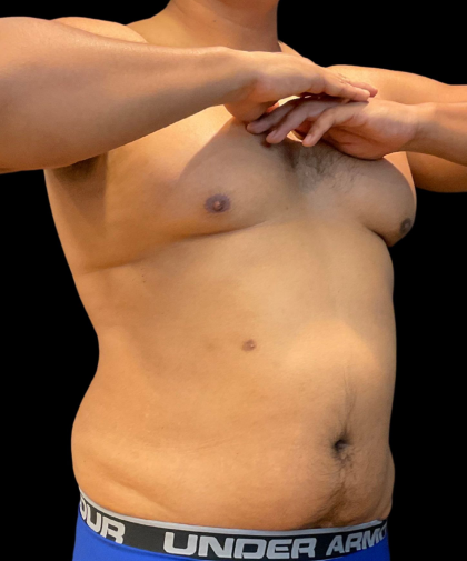 High Definition Liposuction Before & After Patient #12037