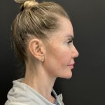 Instalift Before & After Patient #12234