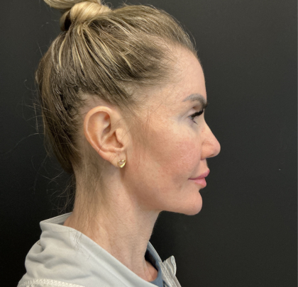 Instalift Before & After Patient #12234