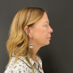 Blepharoplasty Before & After Patient #12228