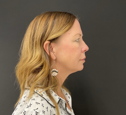 Blepharoplasty Before & After Patient #12228